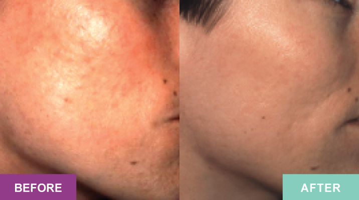 Mask_Peel_Before-after1